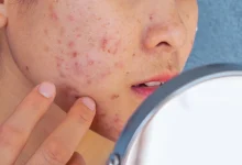 acne-prone-skin