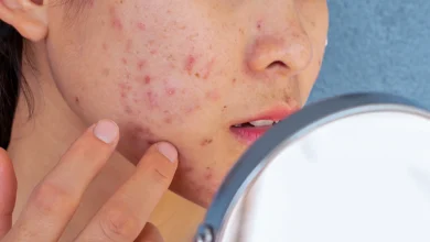 acne-prone-skin