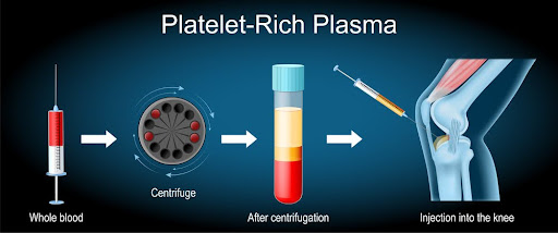 Key Things You Might Not Know About Regenerative Therapies