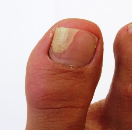 What Are the Common Causes of Pus Under the Toenail