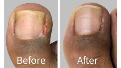 Where to Find Expert Care for Removed Ingrown Toenail