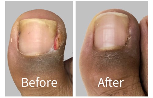 Where to Find Expert Care for Removed Ingrown Toenail