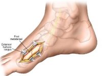 Where to Get the Best First Metatarsal Surgery