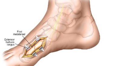 Where to Get the Best First Metatarsal Surgery