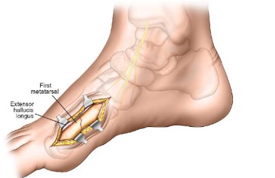 Where to Get the Best First Metatarsal Surgery