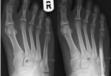 Where to Get the Best Metatarsal Fracture Surgery in AZ