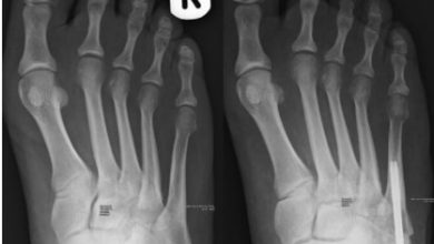 Where to Get the Best Metatarsal Fracture Surgery in AZ