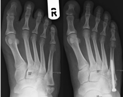 Where to Get the Best Metatarsal Fracture Surgery in AZ