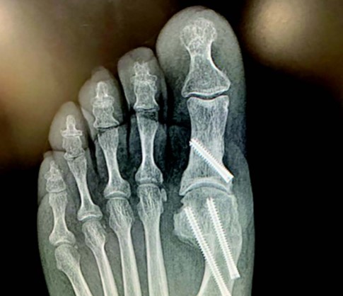 Where to Get the Best Minimally Invasive Bunion Surgery