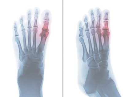 Why is the Metatarsophalangeal Joint Important